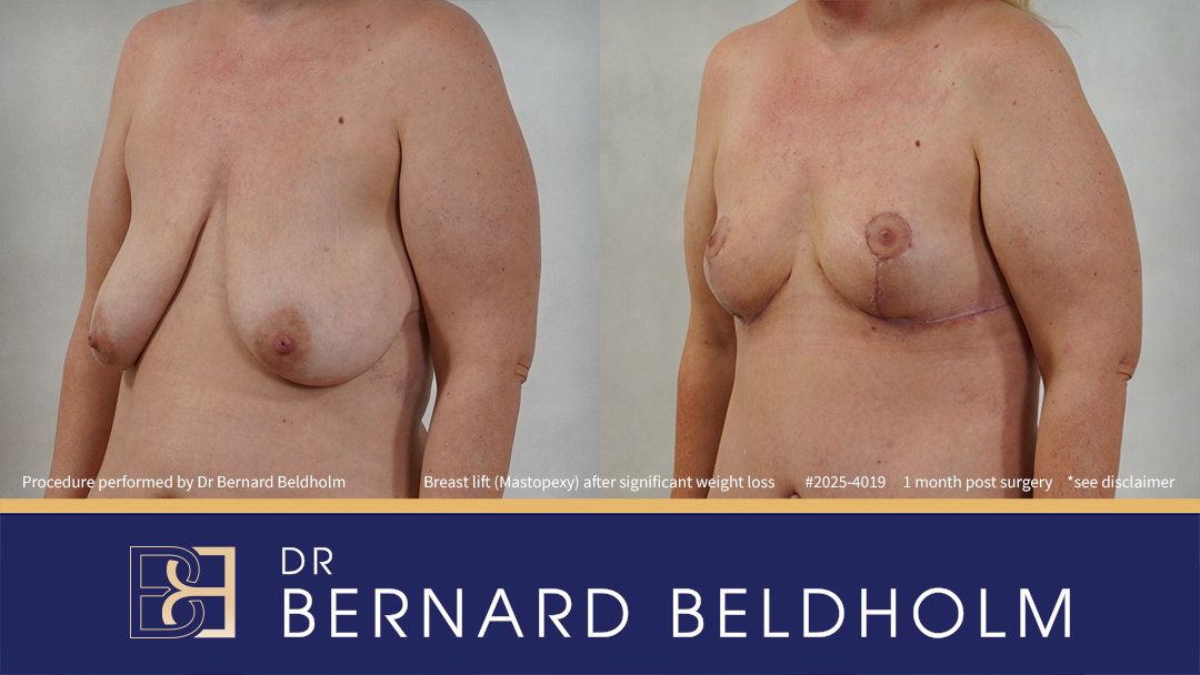 Breast Lift (Mastopexy) After Significant Weight Loss of 40 kg (Patient 2025-4019) - Right