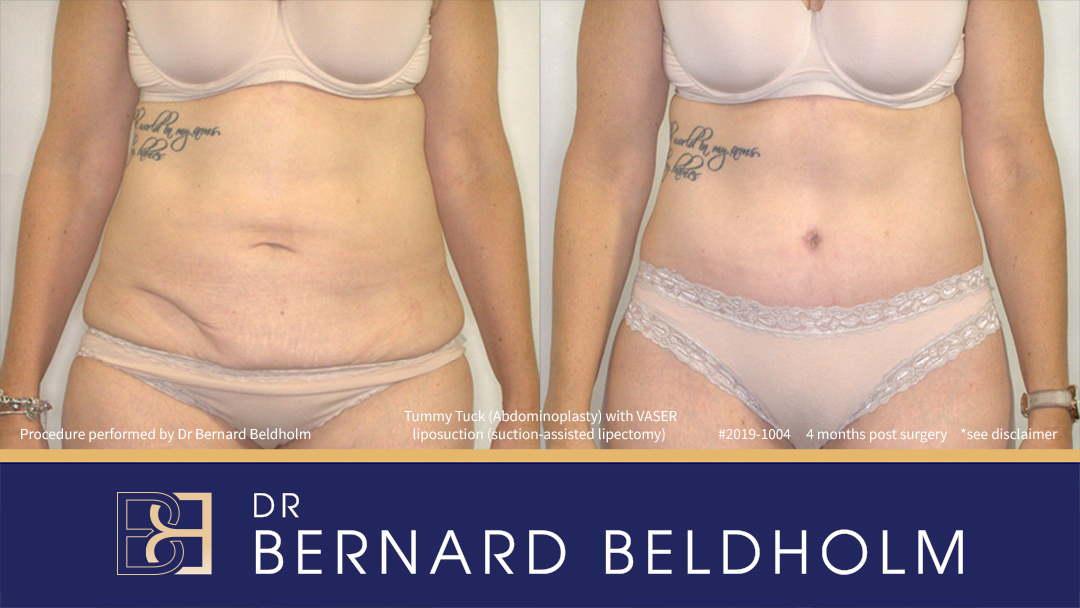 Patient 2019-1004 - Abdominoplasty with VASER Liposuction (Suction-assisted Lipectomy)