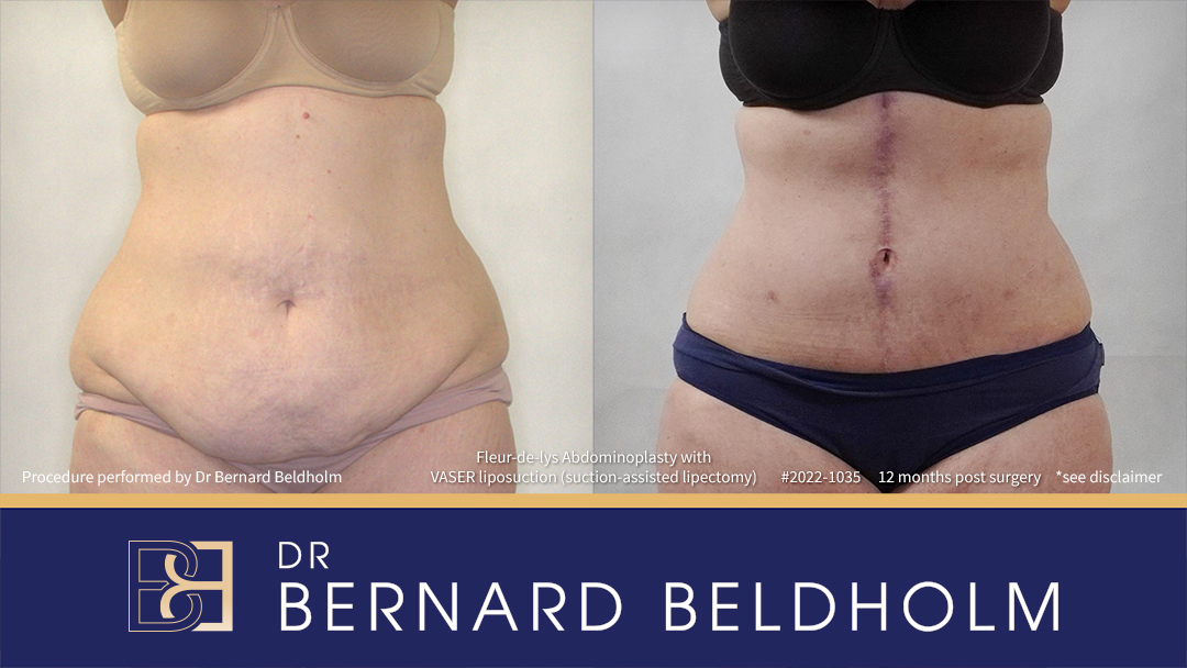 Patient 2022-1035 - Fleur-de-lis Abdominoplasty with VASER Liposuction (Suction-assisted Lipectomy) - Front