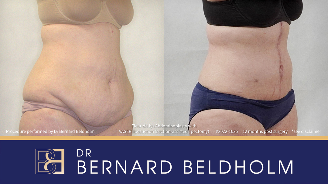 Patient 2022-1035 - Fleur-de-lis Abdominoplasty with VASER Liposuction (Suction-assisted Lipectomy) - Left