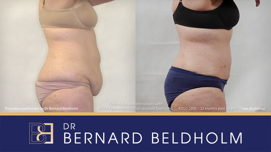 Patient 2022-1035 - Fleur-de-lis Abdominoplasty with VASER Liposuction (Suction-assisted Lipectomy) - Left Side