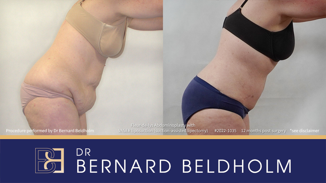 Patient 2022-1035 - Fleur-de-lis Abdominoplasty with VASER Liposuction (Suction-assisted Lipectomy) - Left Side Bend