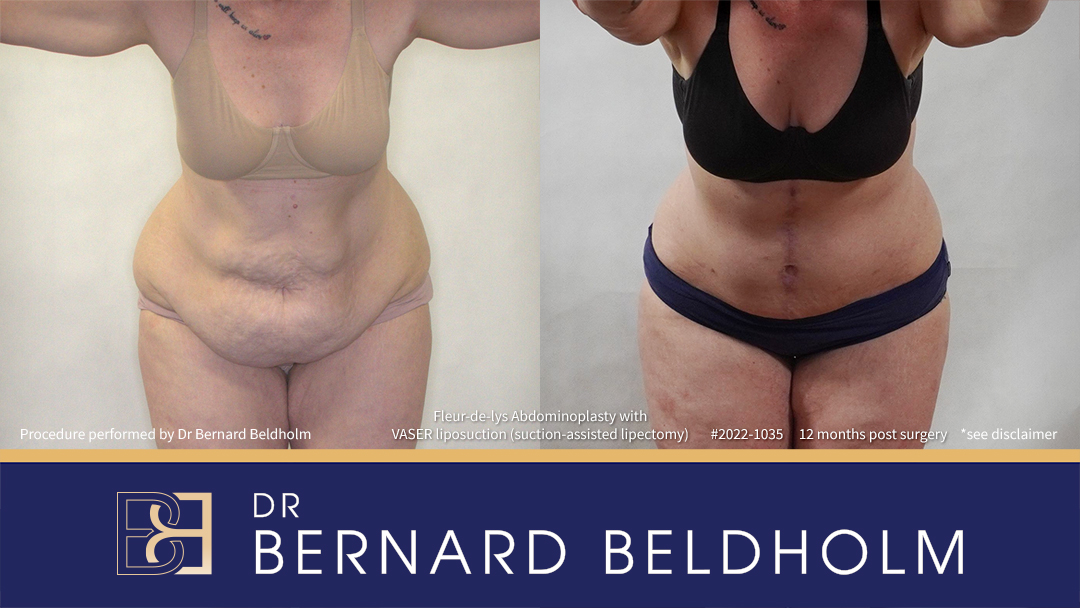 Patient 2022-1035 - Fleur-de-lis Abdominoplasty with VASER Liposuction (Suction-assisted Lipectomy) - Front Bend