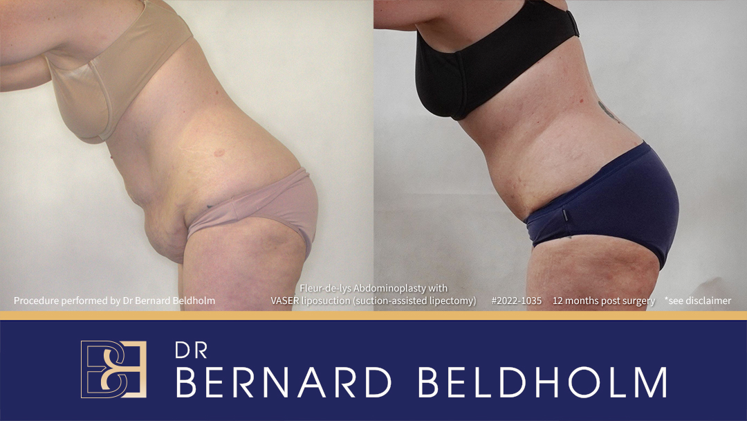 DrBB Website Horizontal Patient 2022 1035 Fleur de lys Abdominoplasty 6