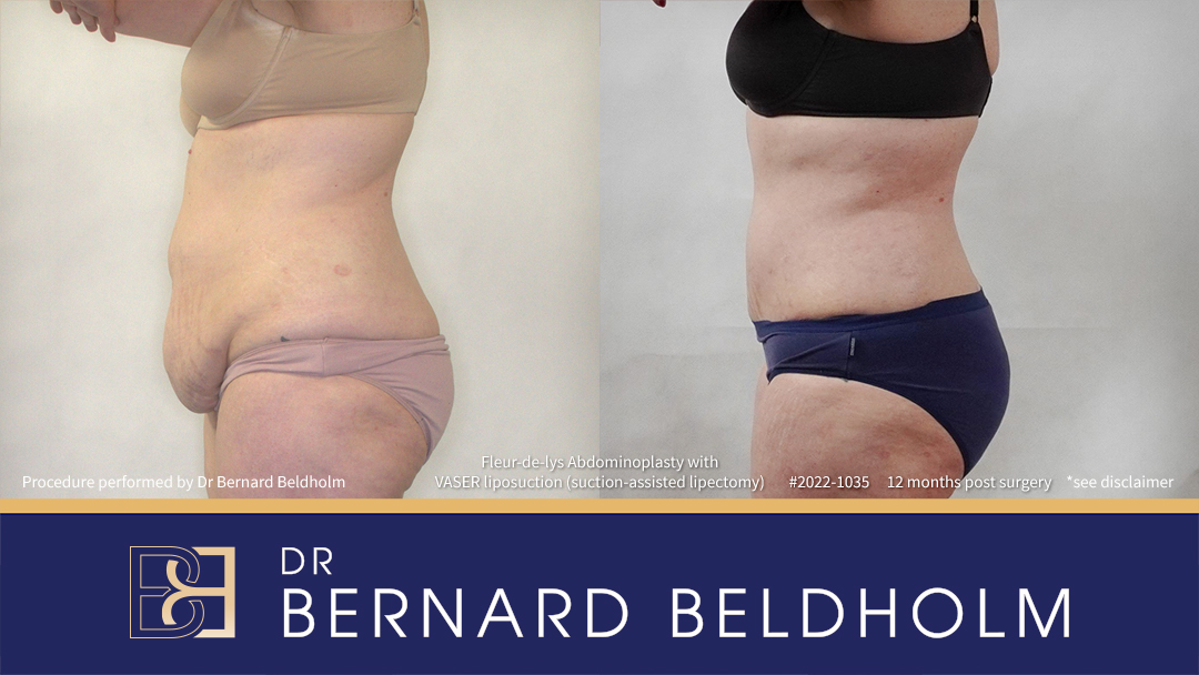 DrBB Website Horizontal Patient 2022 1035 Fleur de lys Abdominoplasty 7