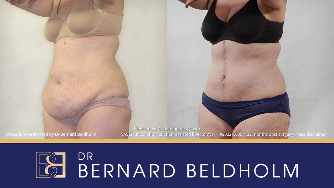 DrBB Website Horizontal Patient 2022 1035 Fleur de lys Abdominoplasty 8