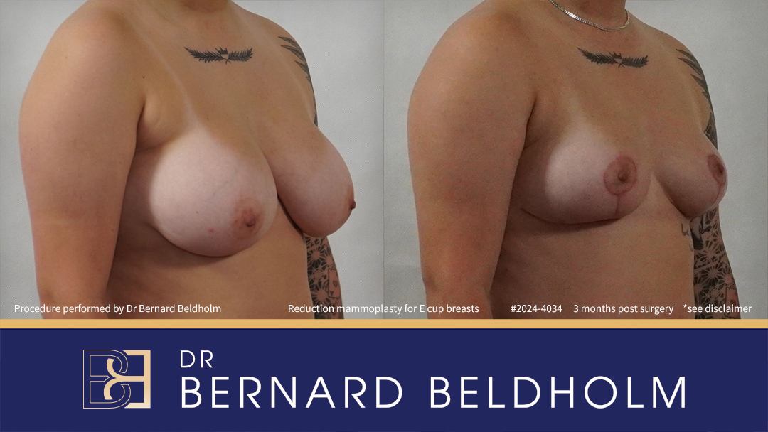 Breast Reduction (Reduction Mammoplasty) for E Cup Breasts (Patient 2023-4034) - Left