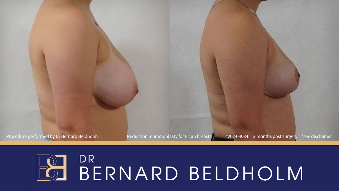 Breast Reduction (Reduction Mammoplasty) for E Cup Breasts (Patient 2023-4034) - Left Side