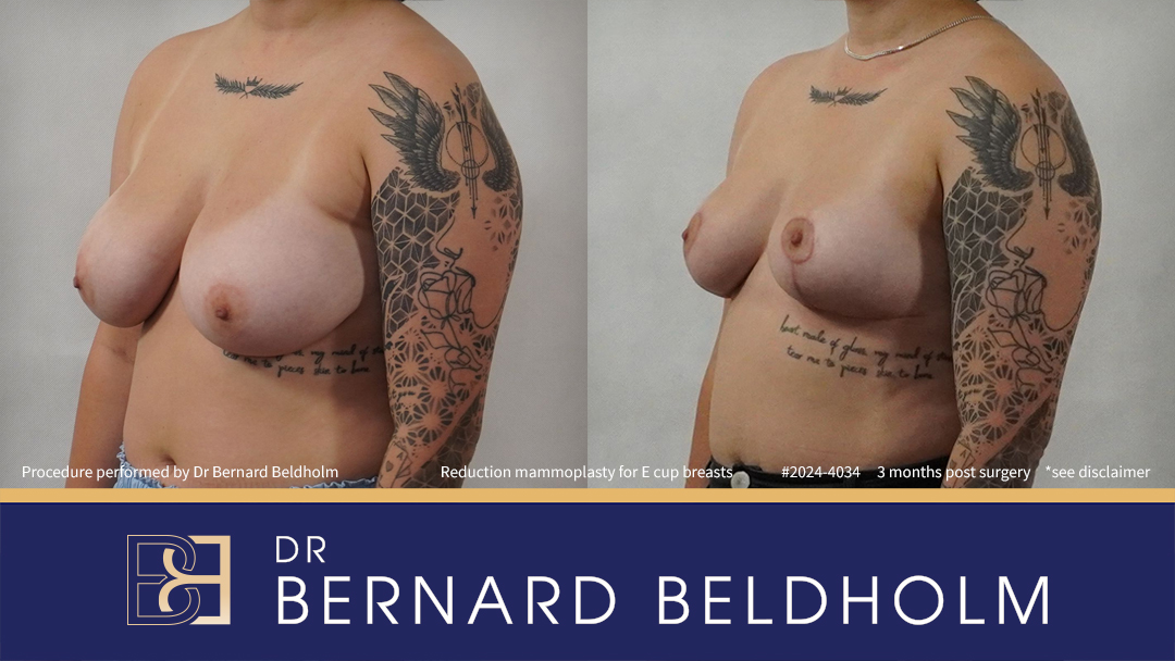 Breast Reduction (Reduction Mammoplasty) for E Cup Breasts (Patient 2023-4034) - Right