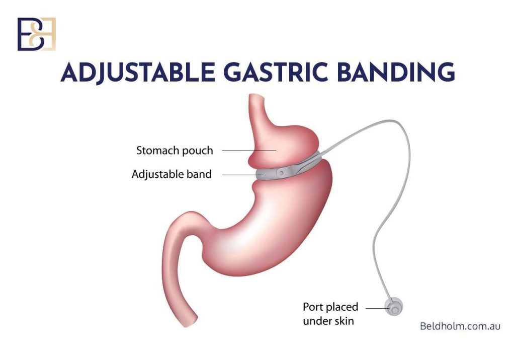 Gastric Banding