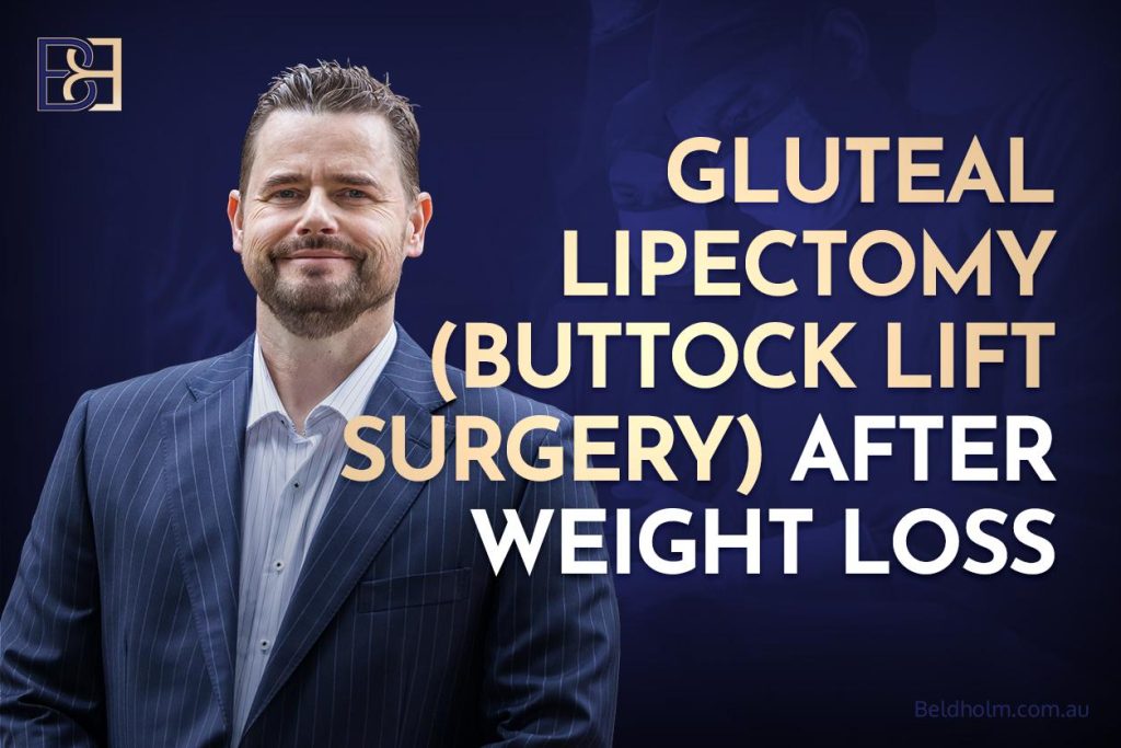 Gluteal Lipectomy (Buttock Lift Surgery) After Weight Loss