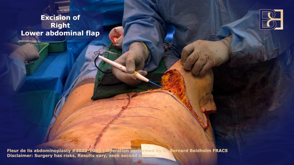 Horizontal Incision and Excision