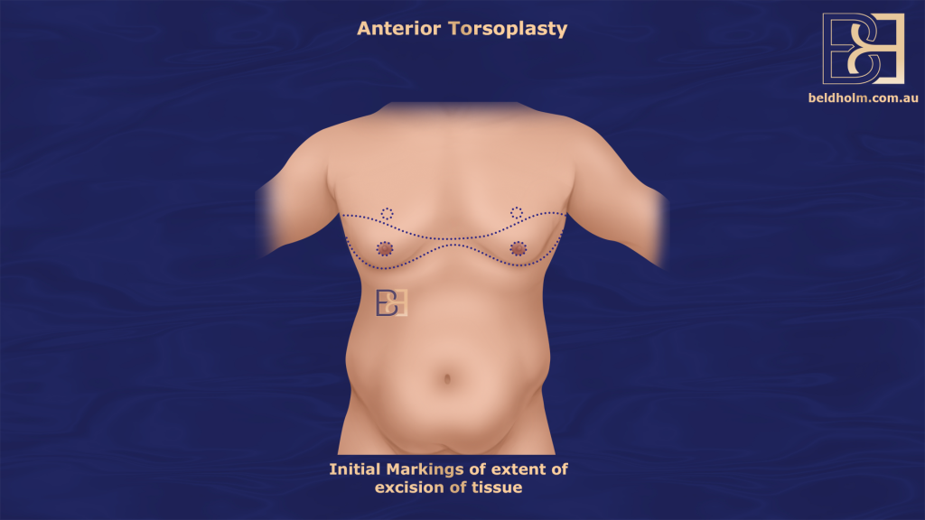 Initial markings for torsoplasty (upper chest lipectomy in men)