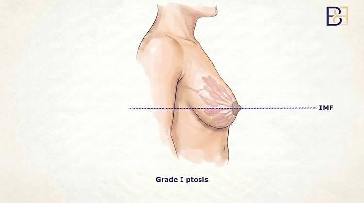 Mild ptosis (Grade 1)