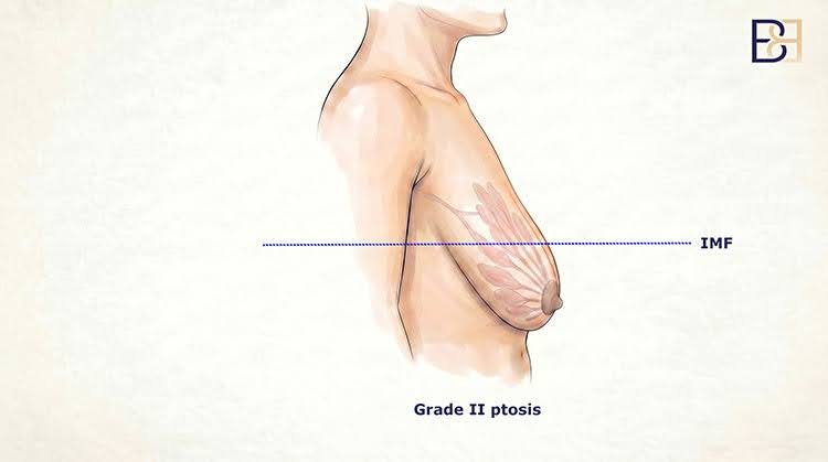 Moderate ptosis (Grade 2)