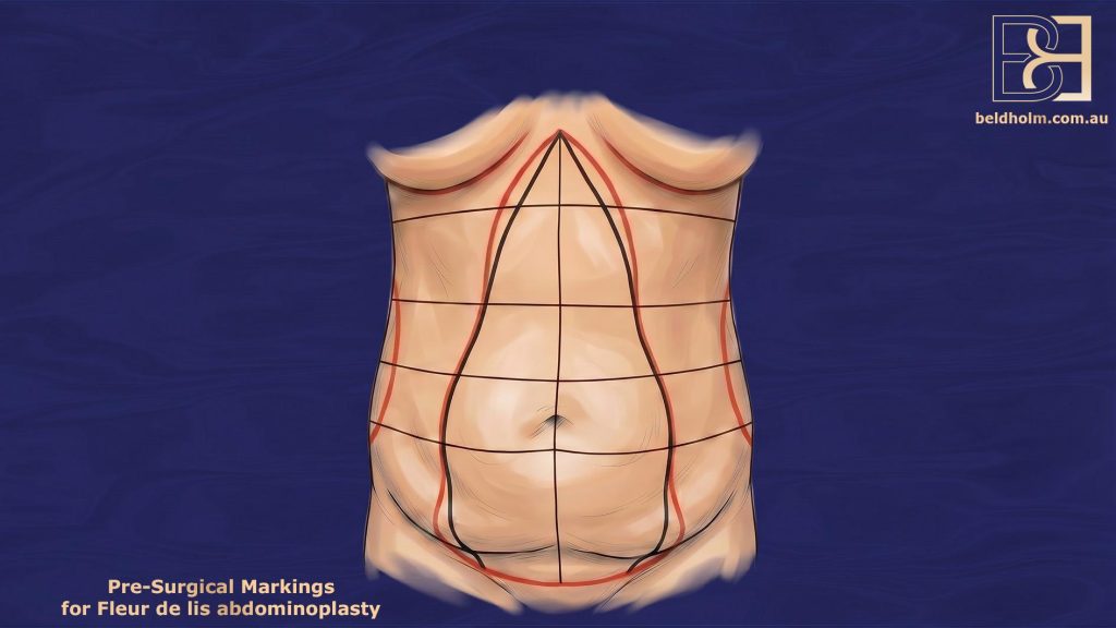 Surgical Markings