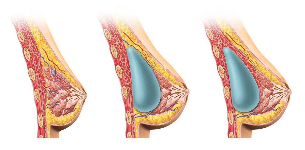 breast
