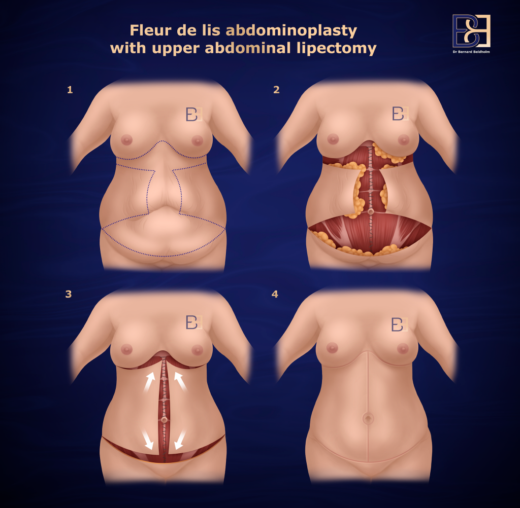 fleur de lis abdominoplasty with upper abdominal lipectomy