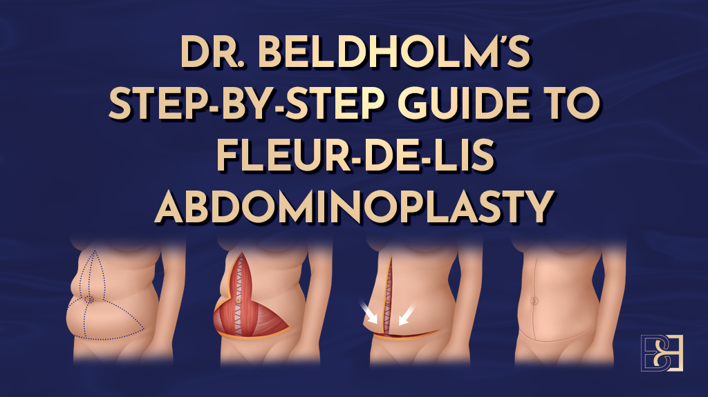 Step by Step Guide to Fleur de Lis Abdominoplasty Operation