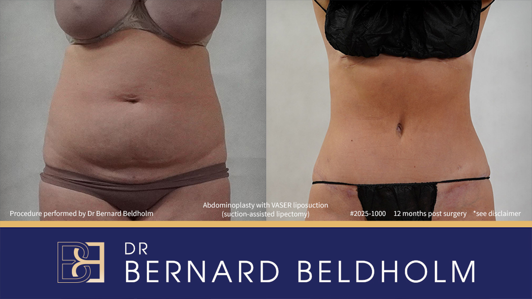 Patient 2025-1000 - Abdominoplasty with VASER Liposuction (Suction-assisted Lipectomy) Post Pregnancy and Diastasis Recti Repair