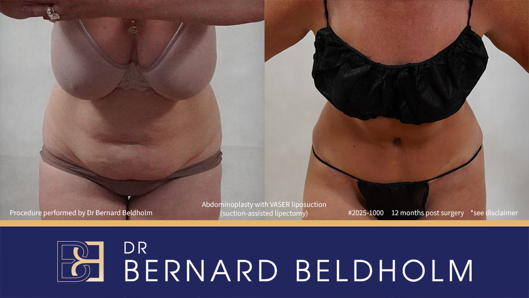 Patient 2025-1000 - Abdominoplasty with VASER Liposuction (Suction-assisted Lipectomy) Post Pregnancy and Diastasis Recti Repair - Front Bend