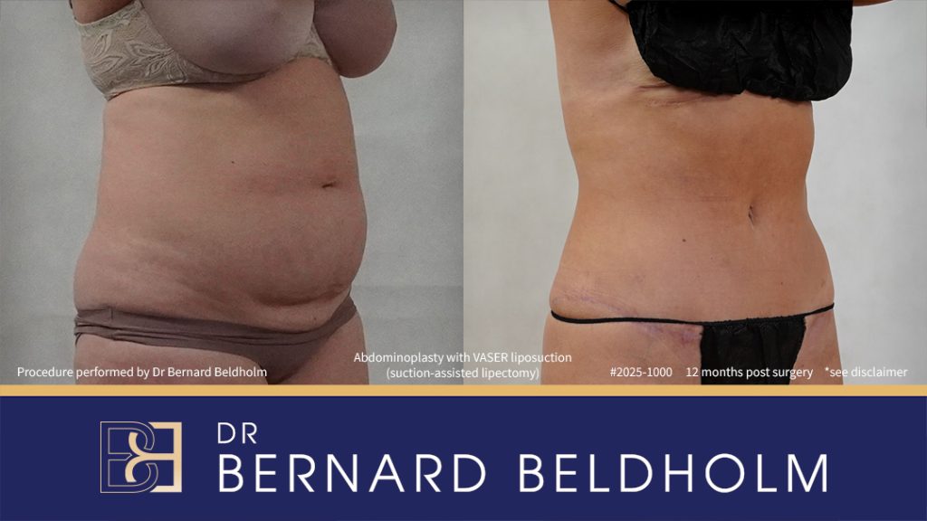 Patient 2025-1000 - Abdominoplasty with VASER Liposuction (Suction-assisted Lipectomy) Post Pregnancy and Diastasis Recti Repair - Left
