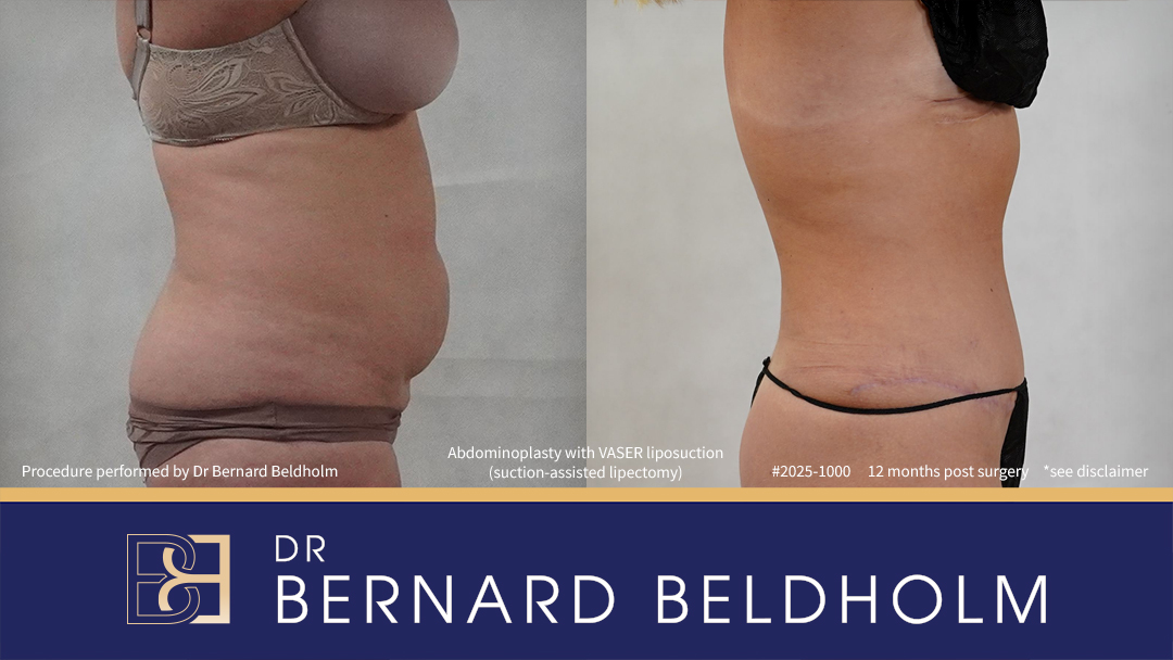 Patient 2025-1000 - Abdominoplasty with VASER Liposuction (Suction-assisted Lipectomy) Post Pregnancy and Diastasis Recti Repair - Left Side