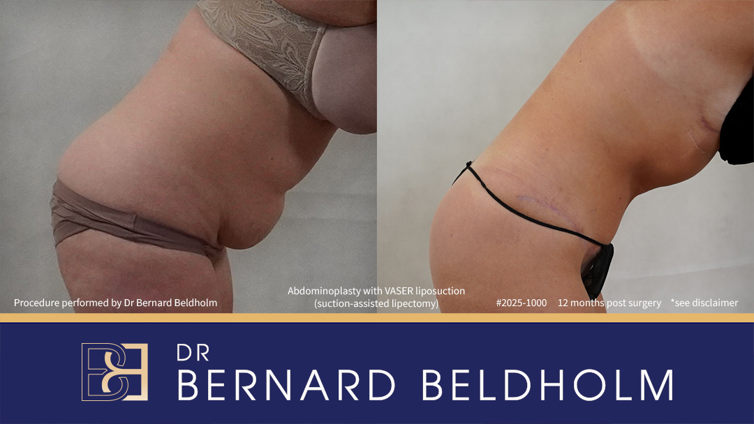 Patient 2025-1000 - Abdominoplasty with VASER Liposuction (Suction-assisted Lipectomy) Post Pregnancy and Diastasis Recti Repair - Left Side Bend