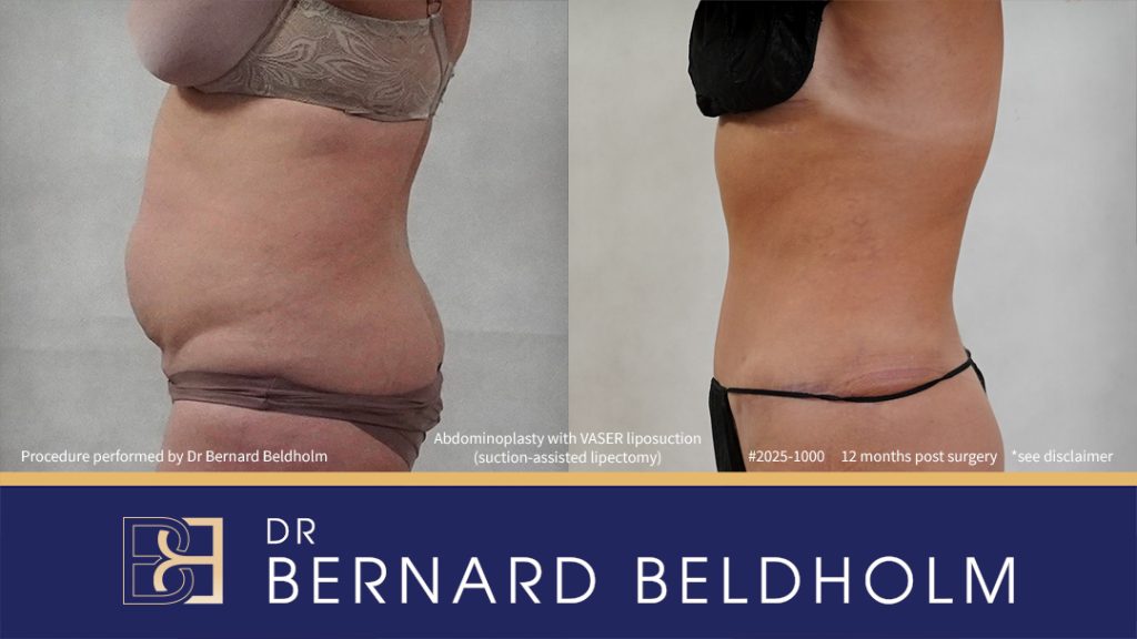 Patient 2025-1000 - Abdominoplasty with VASER Liposuction (Suction-assisted Lipectomy) Post Pregnancy and Diastasis Recti Repair - Right Side