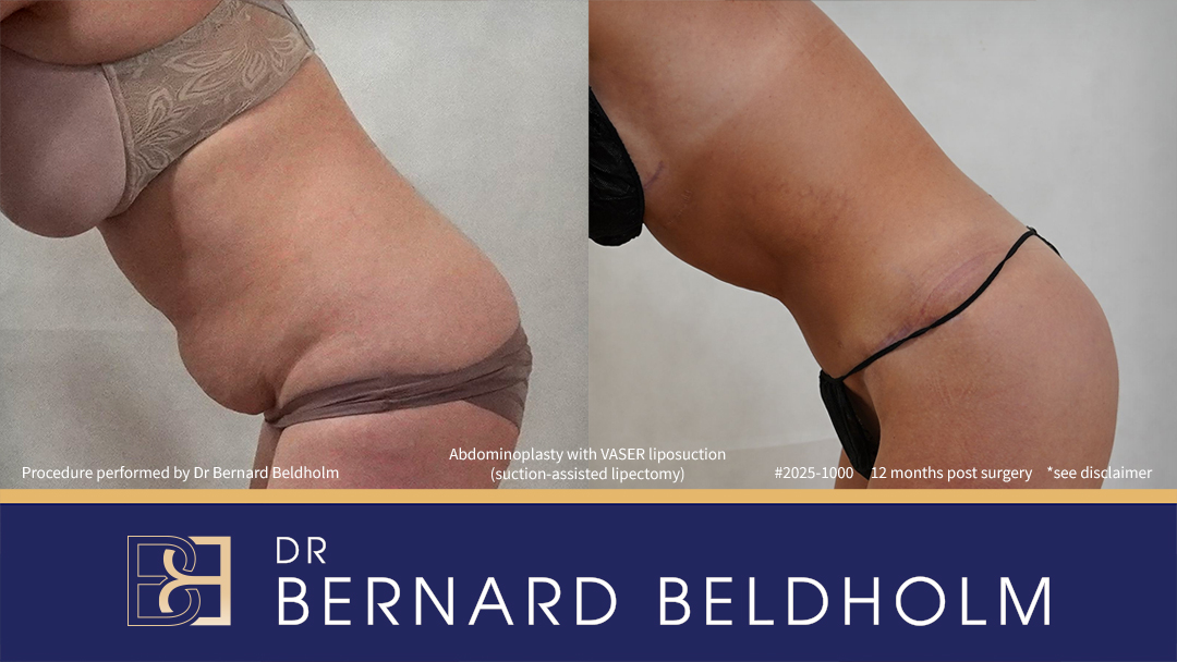 Patient 2025-1000 - Abdominoplasty with VASER Liposuction (Suction-assisted Lipectomy) Post Pregnancy and Diastasis Recti Repair - Right Side Bend