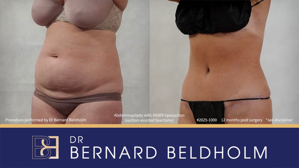 Patient 2025-1000 - Abdominoplasty with VASER Liposuction (Suction-assisted Lipectomy) Post Pregnancy and Diastasis Recti Repair - Right