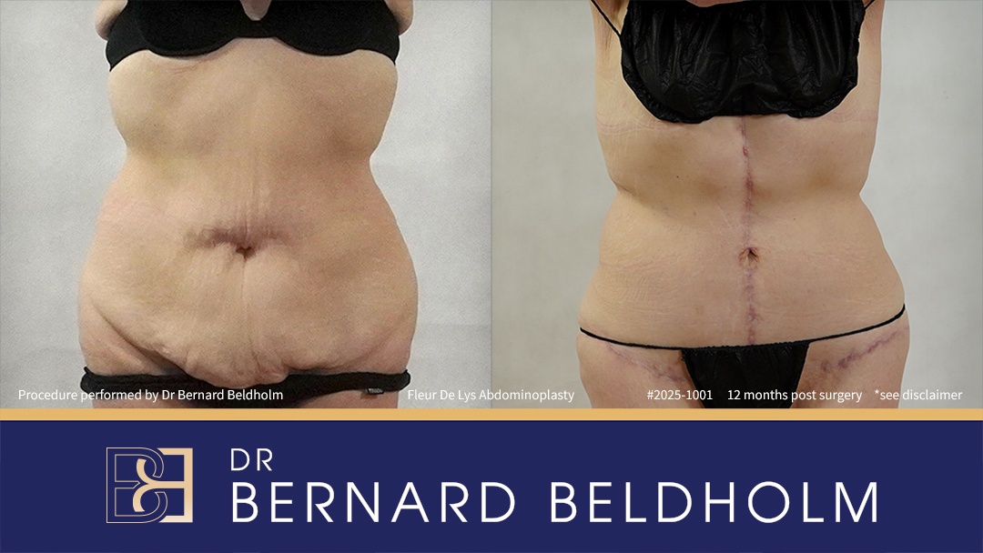 Patient 2025-1001 - Fleur De Lis Abdominoplasty Post Weight Loss