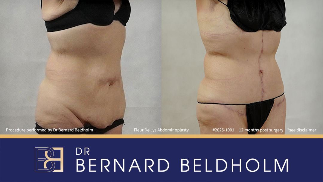 Patient 2025-1001 - Fleur De Lis Abdominoplasty Post Weight Loss - Left