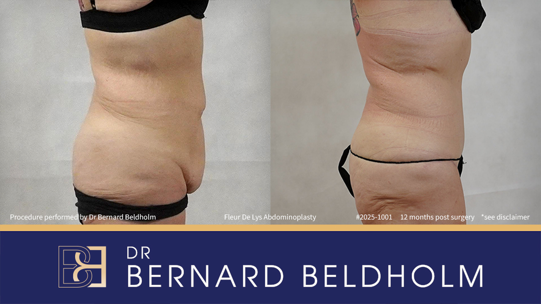 Patient 2025-1001 - Fleur De Lis Abdominoplasty Post Weight Loss - Left Side
