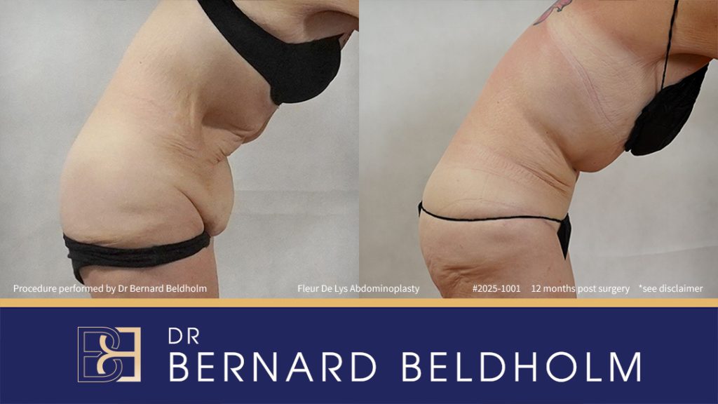 Patient 2025-1001 - Fleur De Lis Abdominoplasty Post Weight Loss - Left Side Bend
