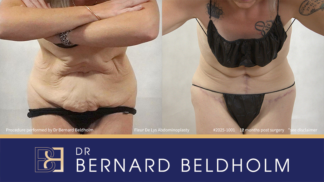 Patient 2025-1001 - Fleur De Lis Abdominoplasty Post Weight Loss - Front Bend