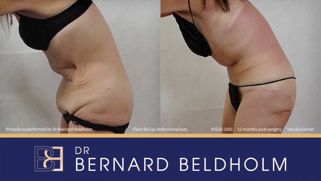 Patient 2025-1001 - Fleur De Lis Abdominoplasty Post Weight Loss - Right Side Bend