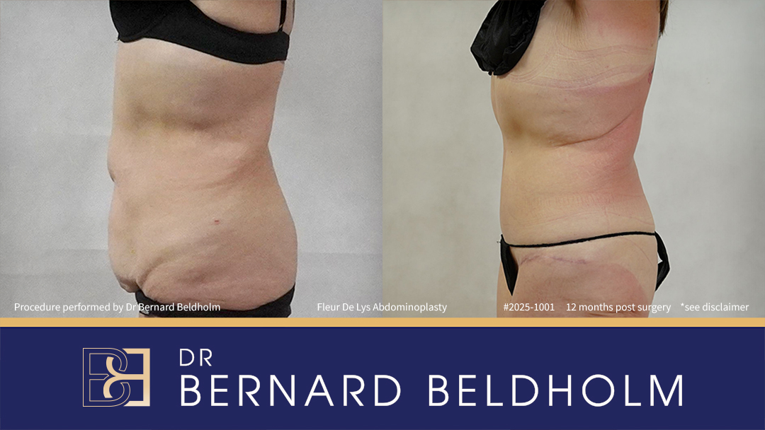 Patient 2025-1001 - Fleur De Lis Abdominoplasty Post Weight Loss - Right Side