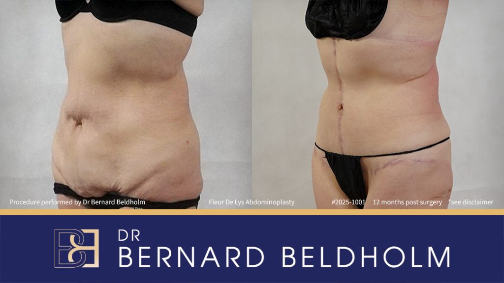 Patient 2025-1001 - Fleur De Lis Abdominoplasty Post Weight Loss - Right