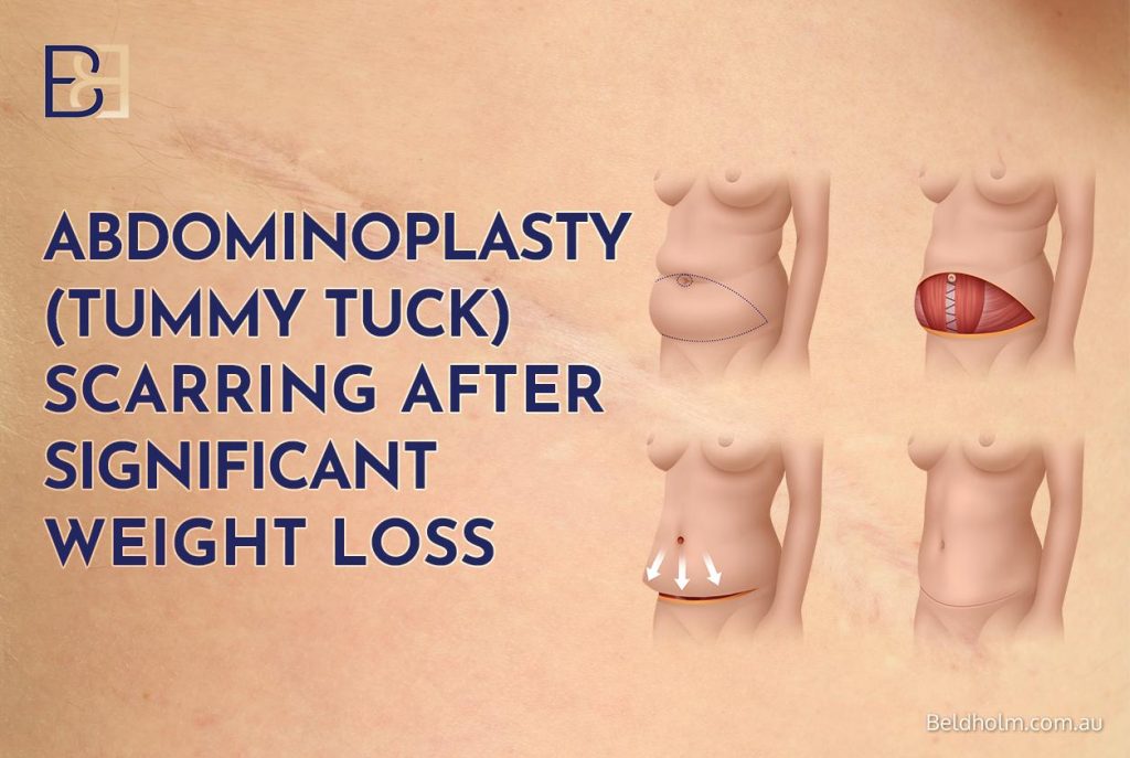 Abdominoplasty (Tummy Tuck) Scarring After Significant Weight Loss