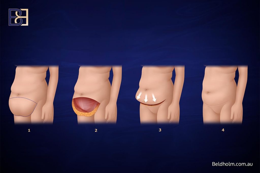 Abdominoplasty (Tummy Tuck) After Weight Loss: A Complete Guide for Post Weight Loss Patients 11 Apronectomy