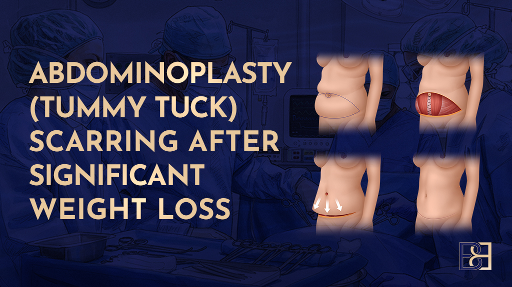 Abdominoplasty (Tummy Tuck) Scarring After Significant Weight Loss
