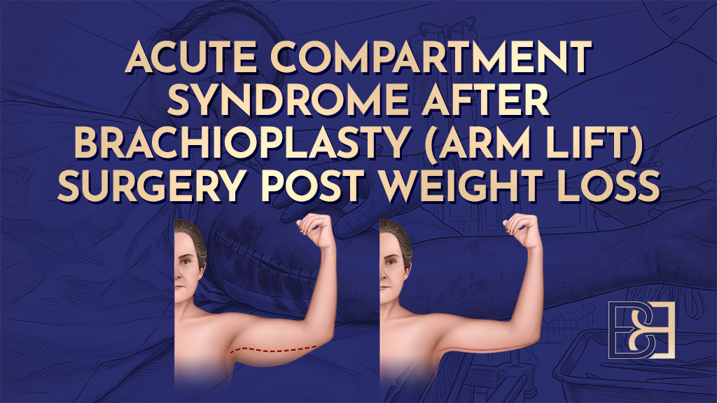 Acute Compartment Syndrome After Brachioplasty (Arm Lift) Surgery Post Weight Loss