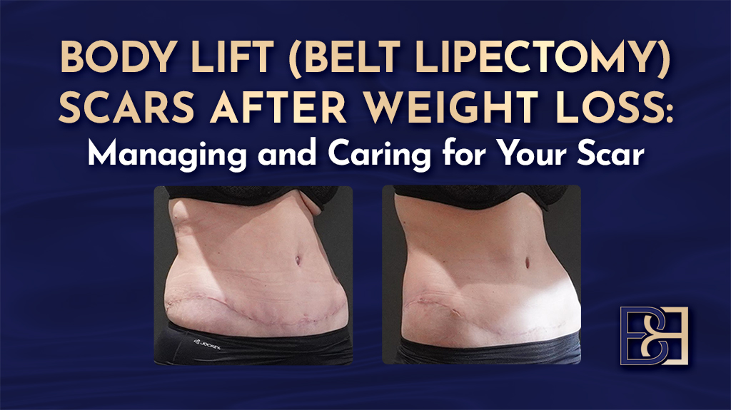 Body Lift (Belt Lipectomy) Scars After Weight Loss: Managing and Caring for Your Scar