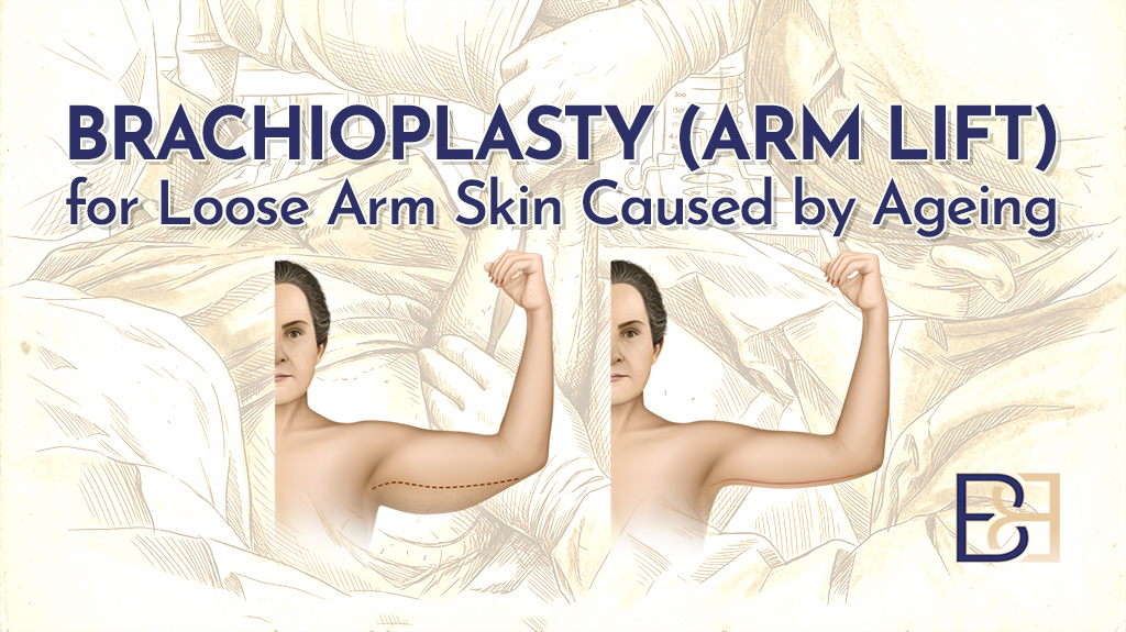 BB_Brachioplasty (Arm Lift) for Loose Arm Skin Caused by Ageing-featured image