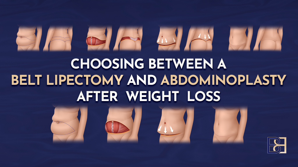 Choosing Between a Belt Lipectomy (Body Lift) and Abdominoplasty (Tummy Tuck) After Weight Loss
