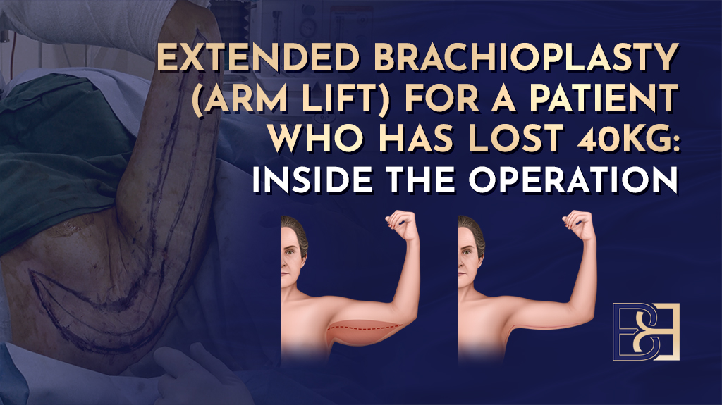 Extended Brachioplasty (Arm Lift) for a Patient Who Has Lost 40kg: Inside the Operation