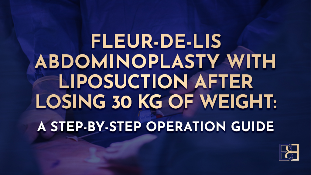 Fleur-de-Lis Abdominoplasty With Liposuction (suction assisted lipectomy) After Losing 30 kg of Weight: A Step-by-Step Operation Guide