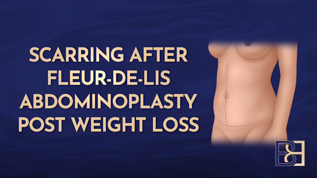 Fleur-de-Lis Abdominoplasty (Tummy Tuck) Scarring After Weight Loss: Risks and Management