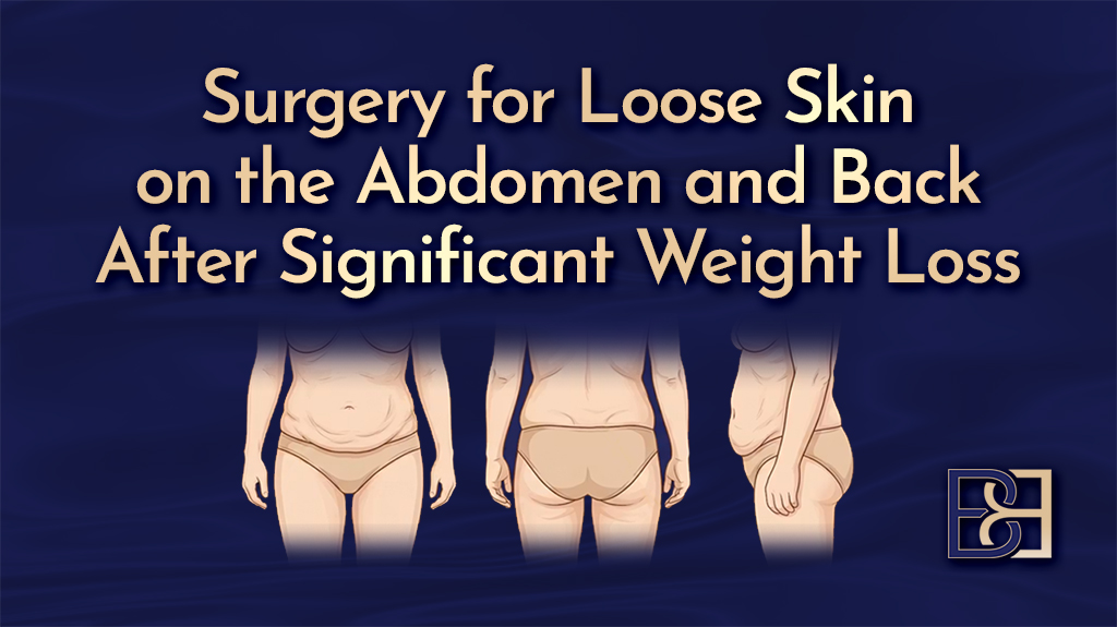 Surgery for Loose Skin on the Abdomen and Back After Significant Weight Loss